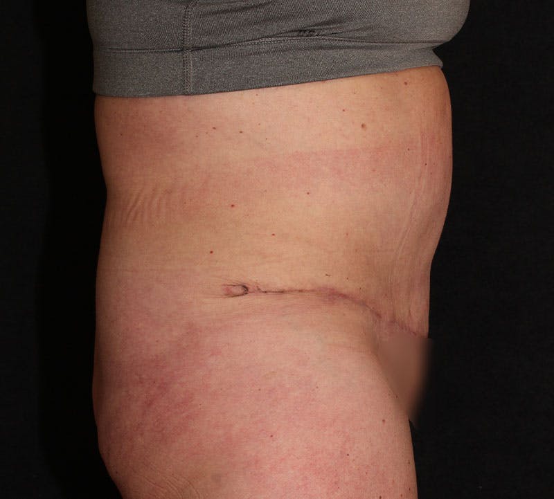 Abdominoplasty (Tummy Tuck) Before & After Gallery - Patient 113323 - Image 6
