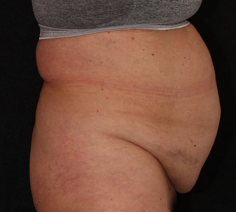 Abdominoplasty (Tummy Tuck) Before & After Gallery - Patient 113323 - Image 5