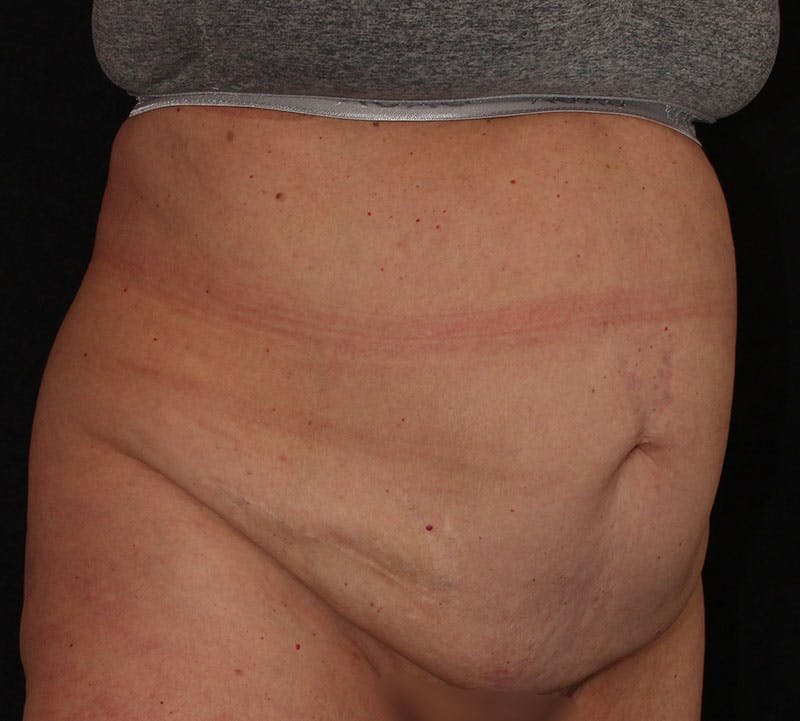 Abdominoplasty (Tummy Tuck) Before & After Gallery - Patient 113323 - Image 3