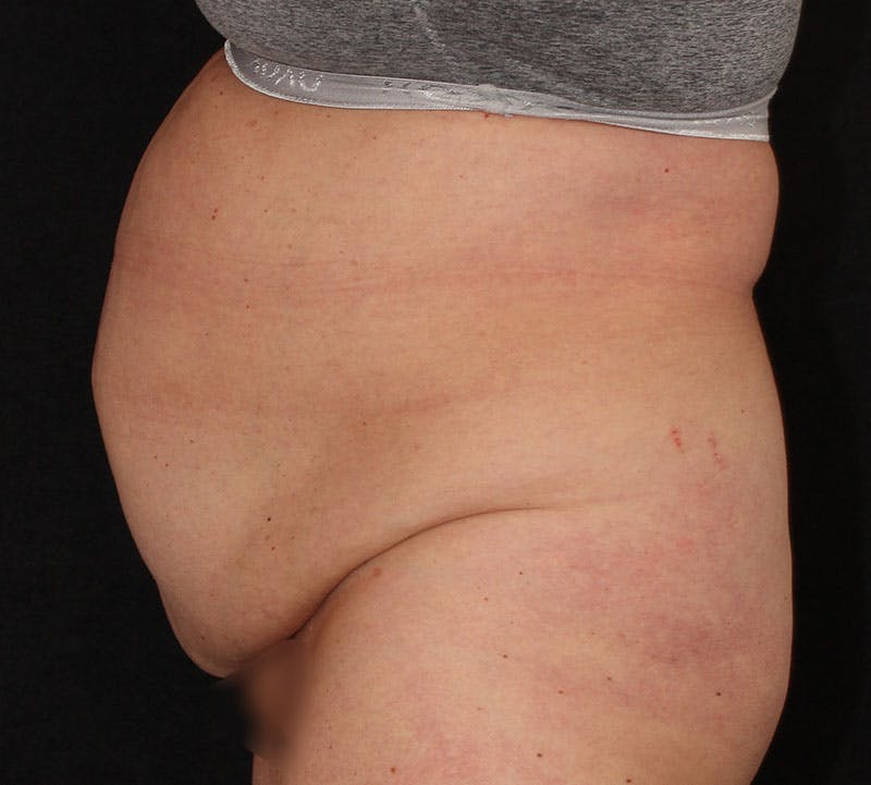 Abdominoplasty (Tummy Tuck) Before & After Gallery - Patient 113323 - Image 7