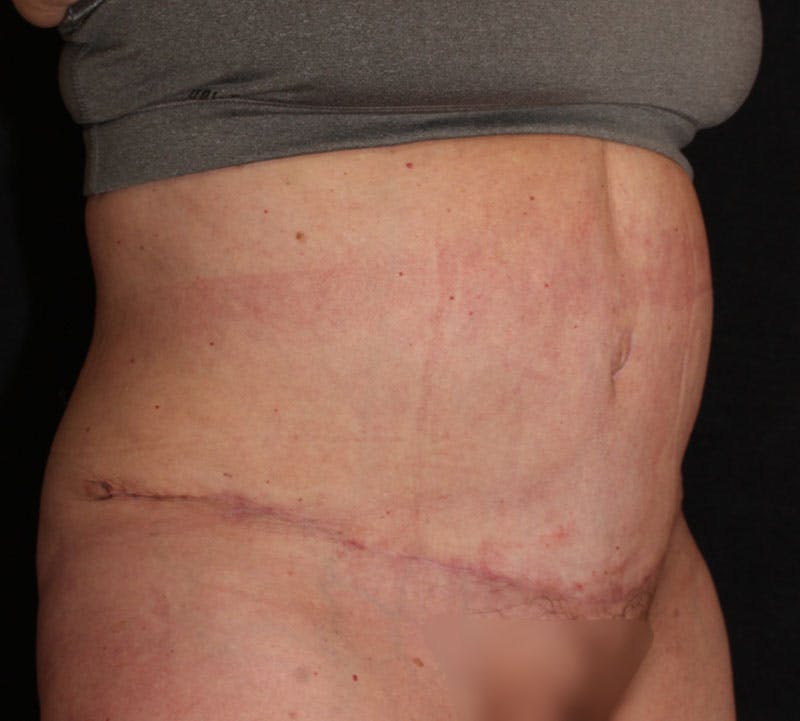 Abdominoplasty (Tummy Tuck) Before & After Gallery - Patient 113323 - Image 4