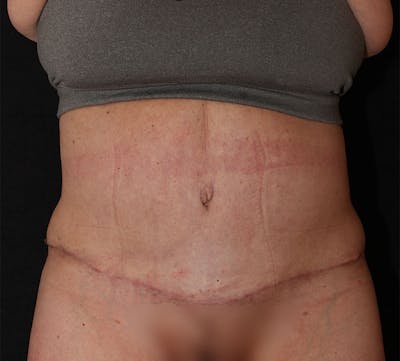 Abdominoplasty (Tummy Tuck) Before & After Gallery - Patient 113323 - Image 2