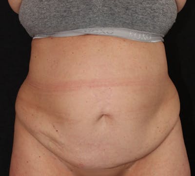 Abdominoplasty (Tummy Tuck) Before & After Gallery - Patient 113323 - Image 1