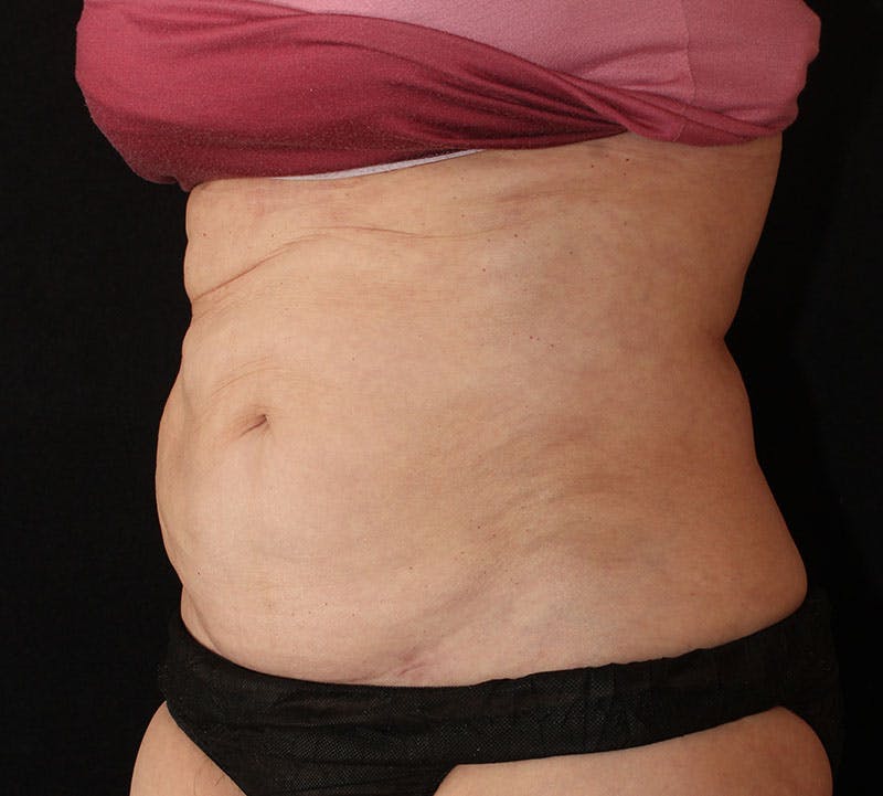 Liposuction Before & After Gallery - Patient 256635 - Image 10