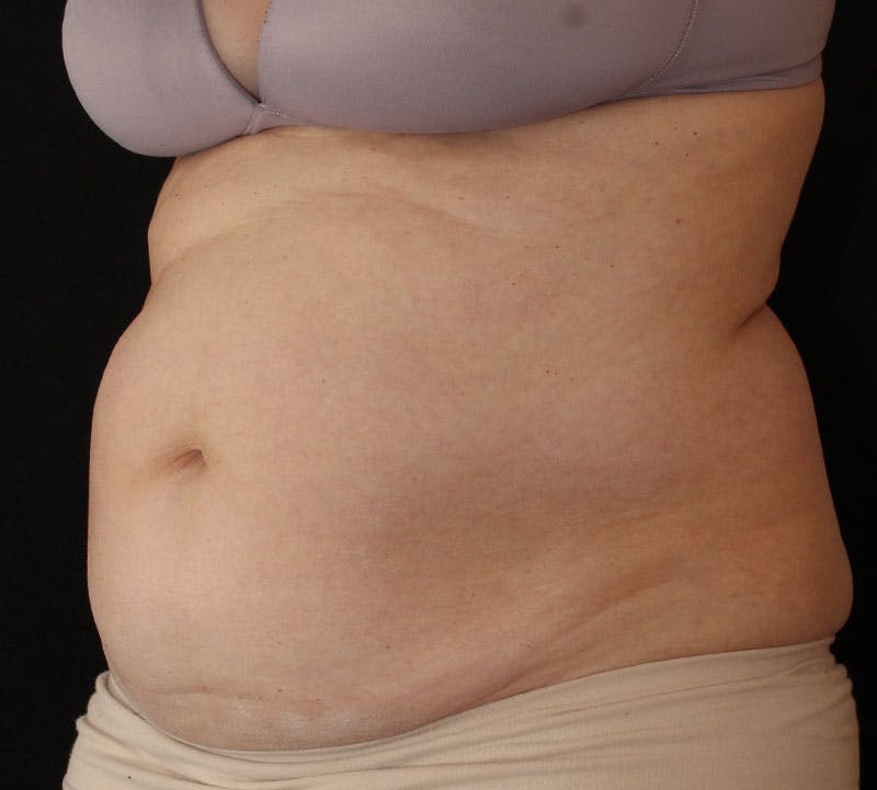 Liposuction Before & After Gallery - Patient 256635 - Image 9