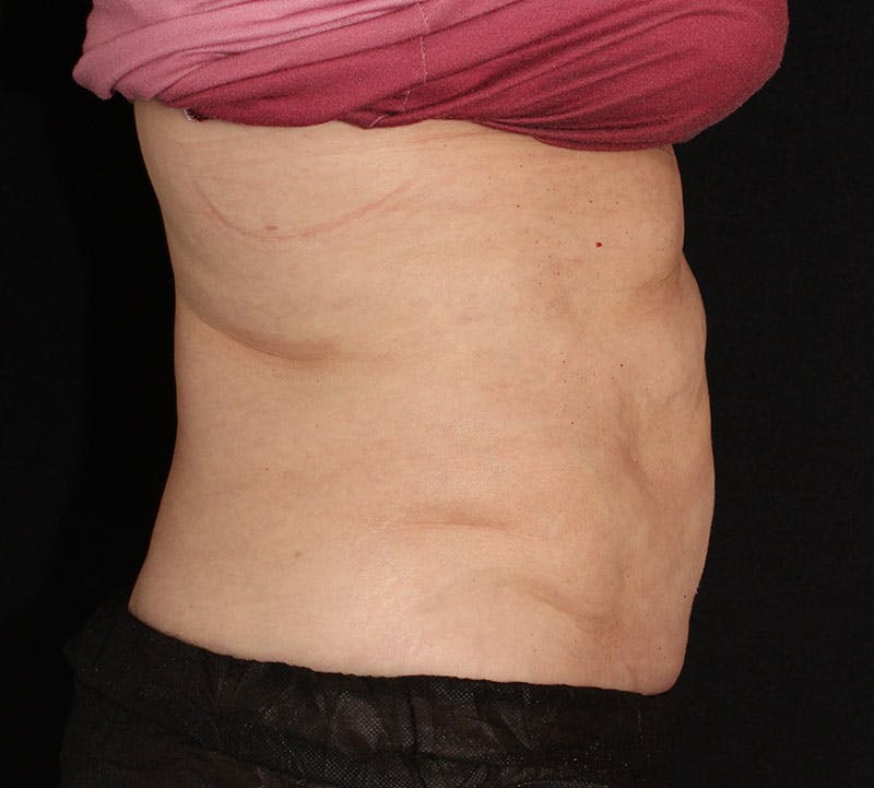 Liposuction Before & After Gallery - Patient 256635 - Image 6