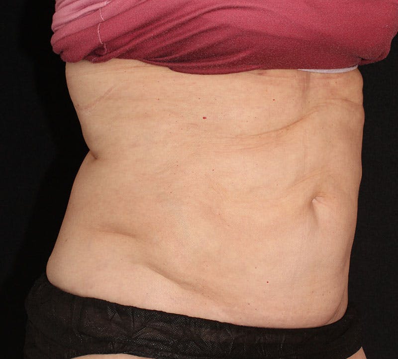 Liposuction Before & After Gallery - Patient 256635 - Image 4