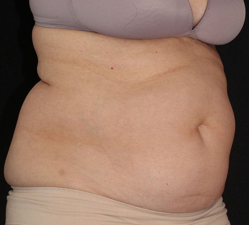 Liposuction Before & After Gallery - Patient 256635 - Image 3
