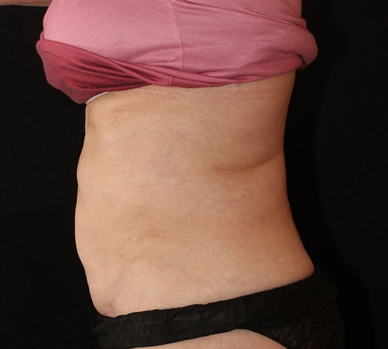 Liposuction Before & After Gallery - Patient 256635 - Image 8