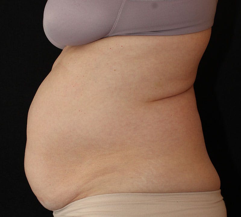 Liposuction Before & After Gallery - Patient 256635 - Image 7
