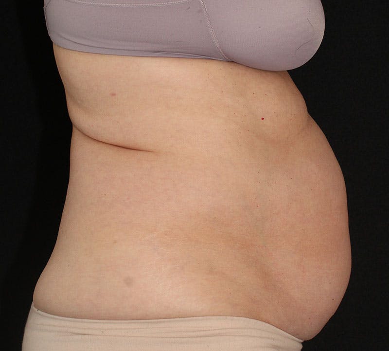 Liposuction Before & After Gallery - Patient 256635 - Image 5