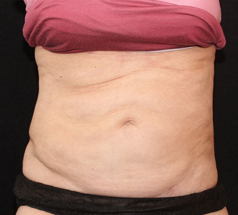Liposuction Before & After Gallery - Patient 256635 - Image 2