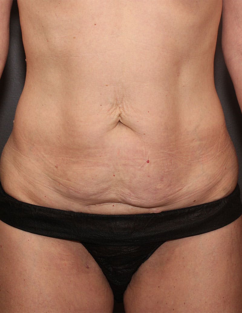 Mommy Makeover Before & After Gallery - Patient 190359 - Image 3