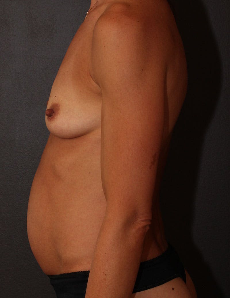 Mommy Makeover Before & After Gallery - Patient 357399 - Image 7