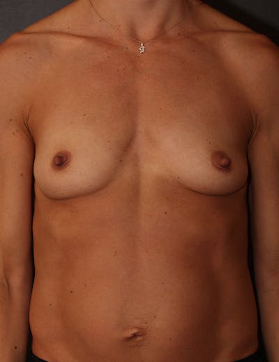 Mommy Makeover Before & After Gallery - Patient 357399 - Image 1