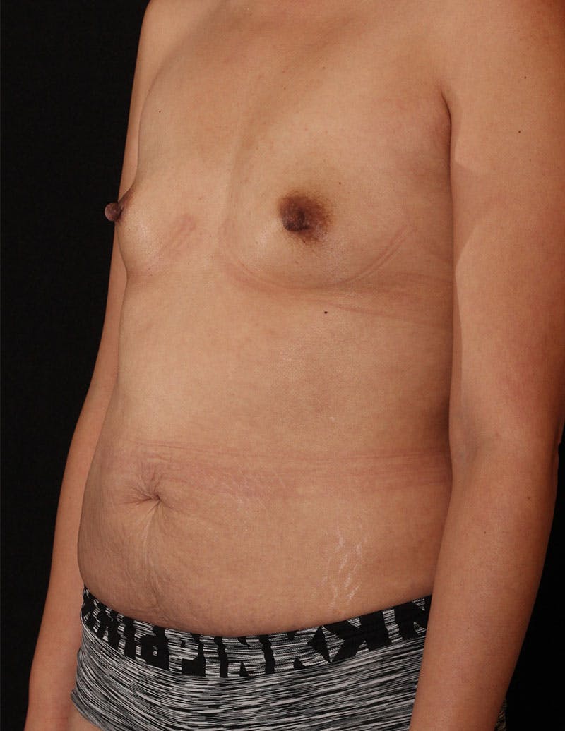 Mommy Makeover Before & After Gallery - Patient 189014 - Image 9