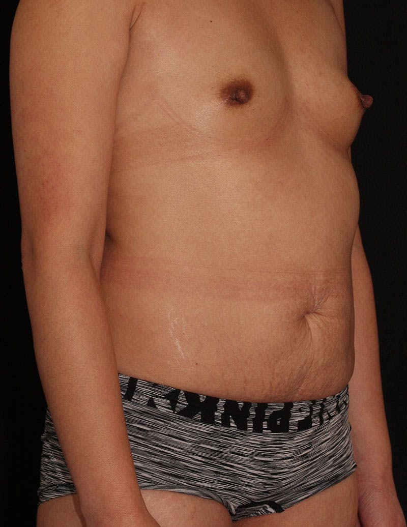 Mommy Makeover Before & After Gallery - Patient 189014 - Image 3