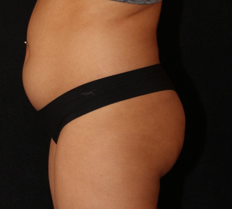 Brazilian Butt Lift Before & After Gallery - Patient 399982 - Image 13