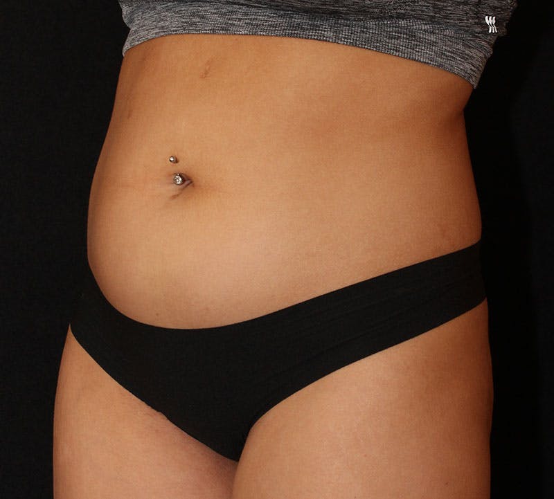 Brazilian Butt Lift Before & After Gallery - Patient 399982 - Image 12