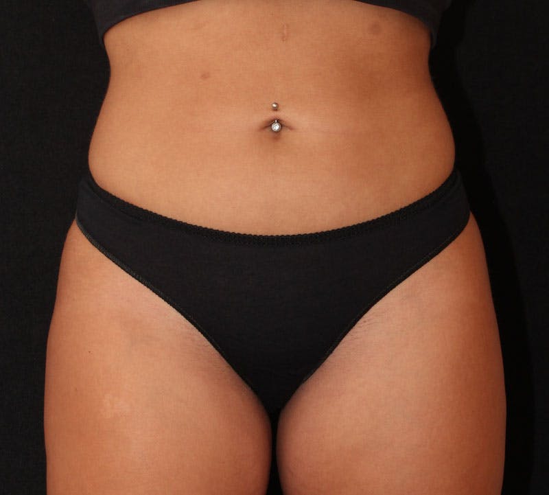Brazilian Butt Lift Before & After Gallery - Patient 399982 - Image 10