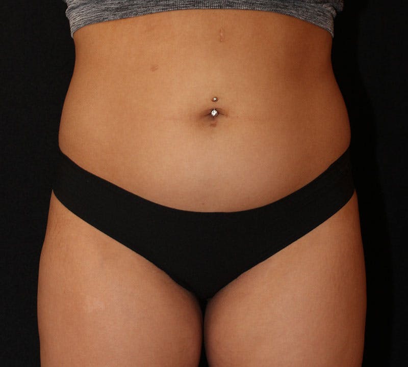 Brazilian Butt Lift Before & After Gallery - Patient 399982 - Image 9