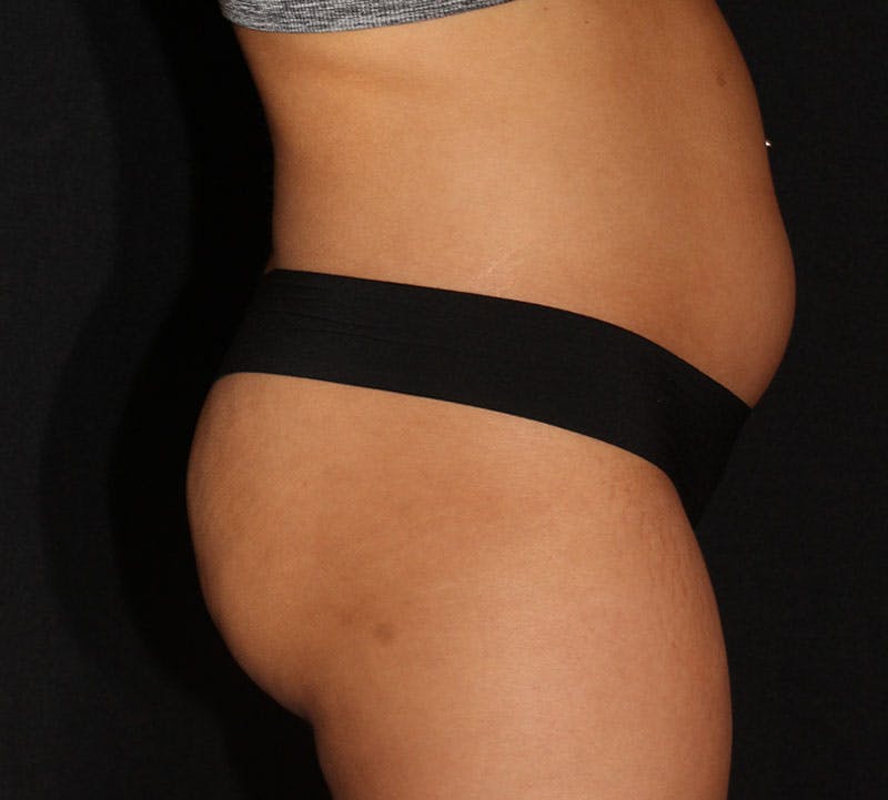 Brazilian Butt Lift Before & After Gallery - Patient 399982 - Image 5