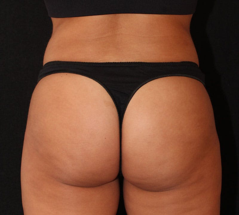 Brazilian Butt Lift Before & After