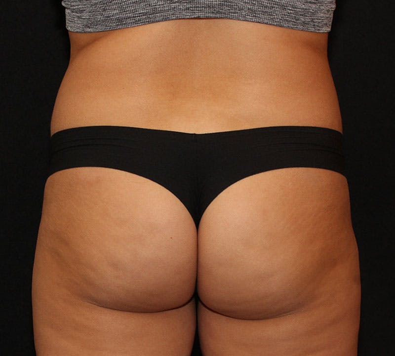 Brazilian Butt Lift Before & After