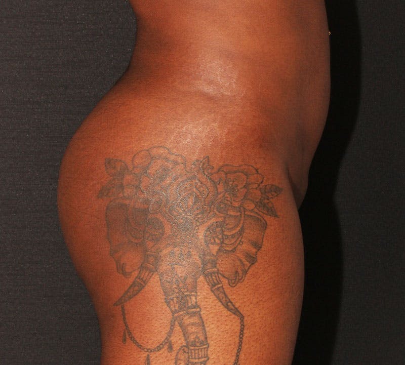 Brazilian Butt Lift Before & After Gallery - Patient 366971 - Image 6