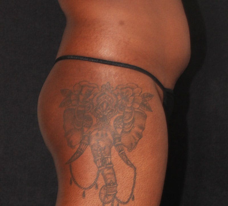 Brazilian Butt Lift Before & After Gallery - Patient 366971 - Image 5