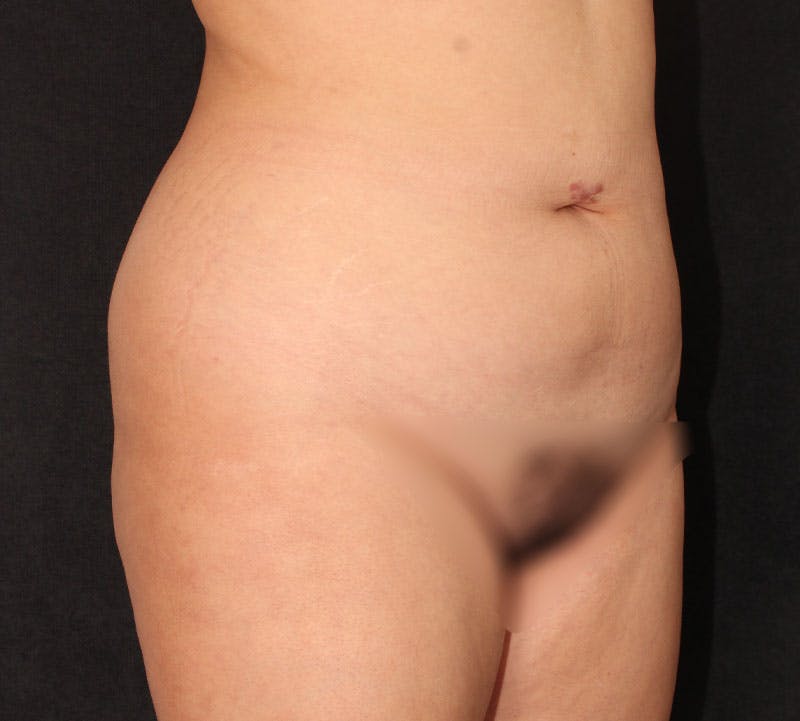Brazilian Butt Lift Before & After Gallery - Patient 115055 - Image 7
