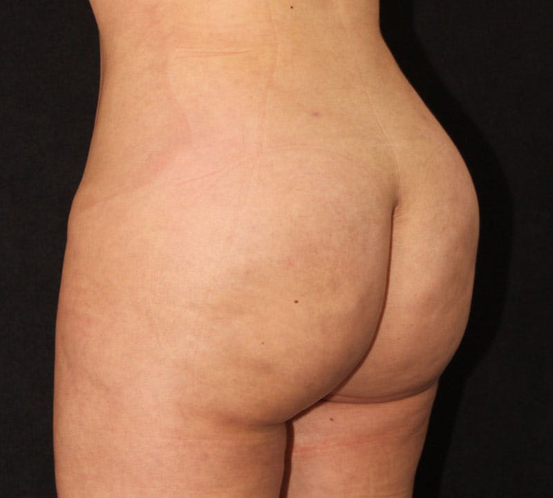 Brazilian Butt Lift Before & After Gallery - Patient 115055 - Image 16