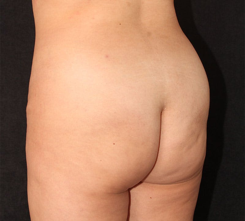 Brazilian Butt Lift Before & After Gallery - Patient 115055 - Image 15
