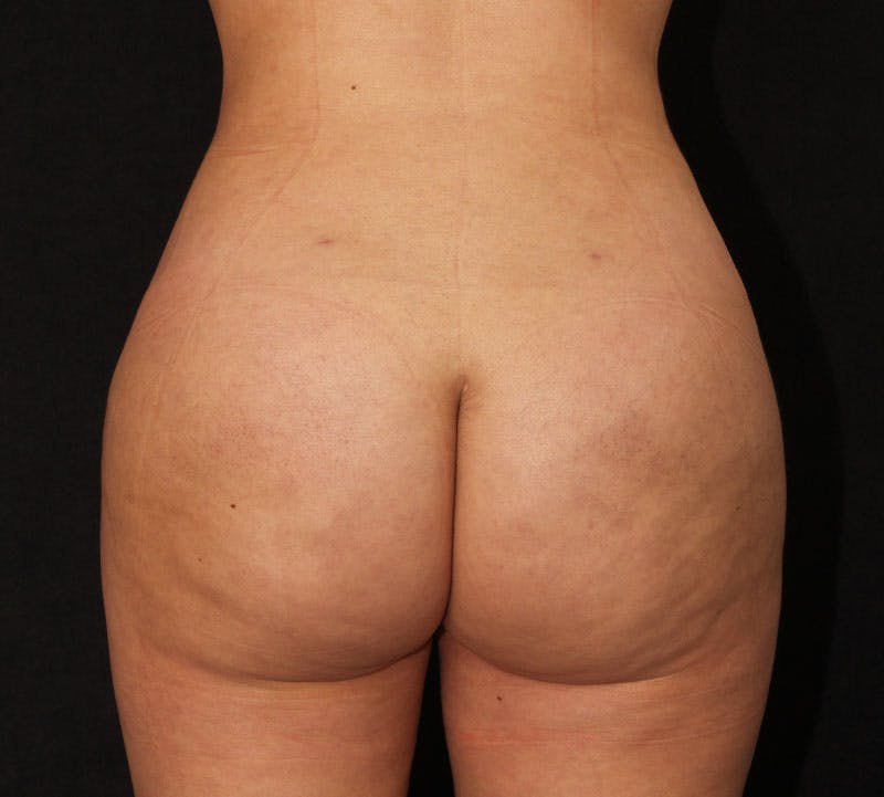 Brazilian Butt Lift Before & After Gallery - Patient 115055 - Image 2