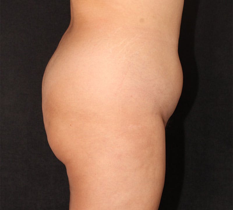 Brazilian Butt Lift Before & After Gallery - Patient 115055 - Image 5