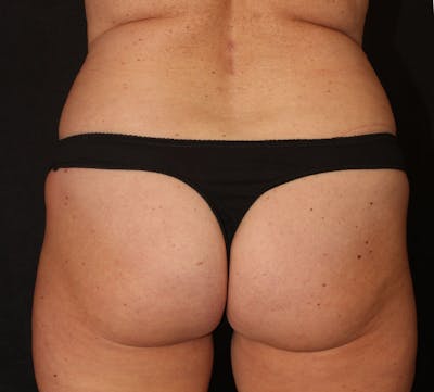 Brazilian Butt Lift Before & After Gallery - Patient 400433 - Image 1