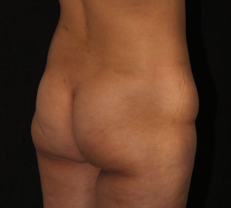 Brazilian Butt Lift Before & After Gallery - Patient 644935 - Image 3