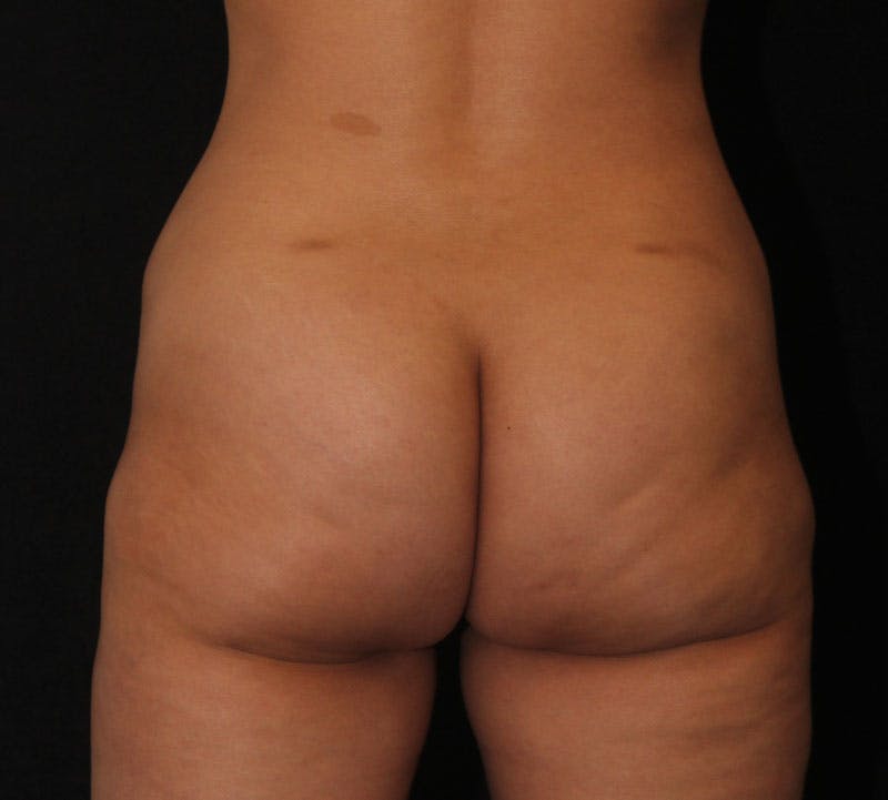 Brazilian Butt Lift Before & After Gallery - Patient 644935 - Image 2