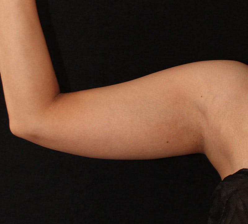 Bodytite Before & After Gallery - Patient 194680 - Image 3