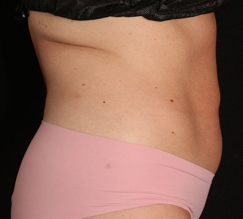 Bodytite Before & After Gallery - Patient 343149 - Image 5
