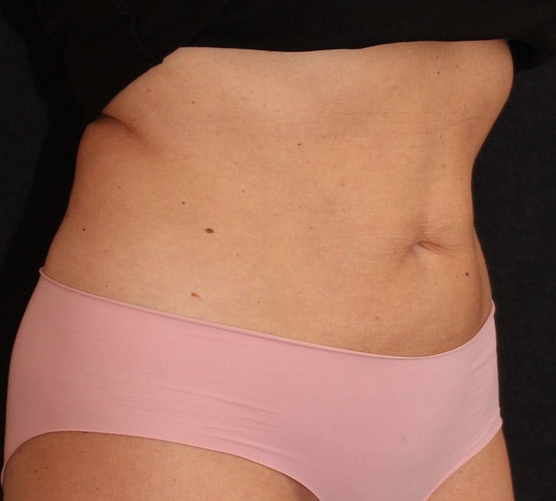 Bodytite Before & After Gallery - Patient 343149 - Image 4