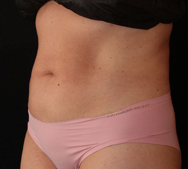 Bodytite Before & After Gallery - Patient 343149 - Image 9