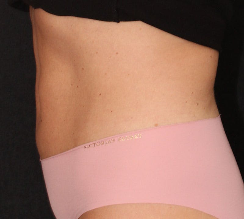 Bodytite Before & After Gallery - Patient 343149 - Image 8