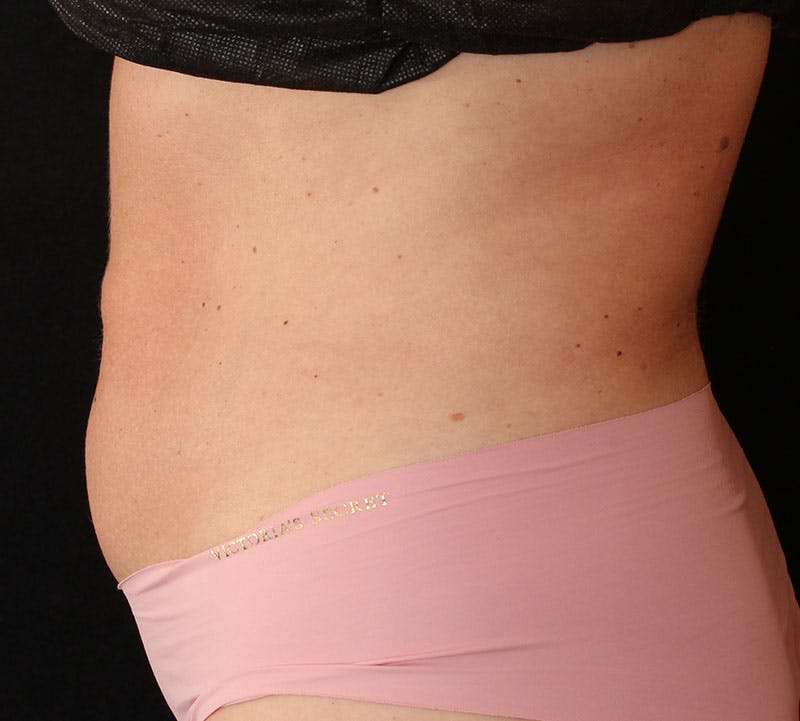 Bodytite Before & After Gallery - Patient 343149 - Image 7