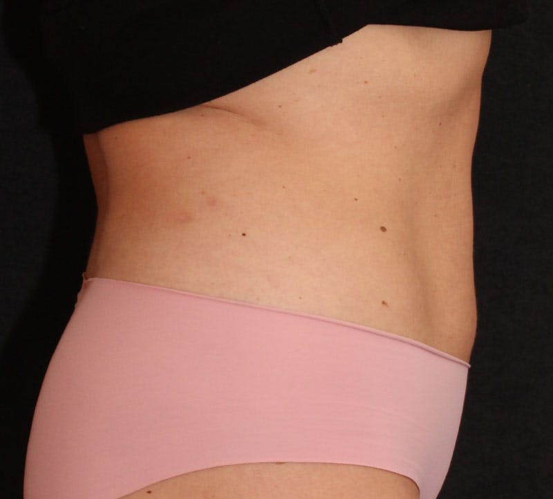 Bodytite Before & After Gallery - Patient 343149 - Image 6