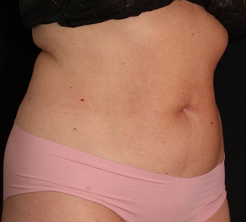 Bodytite Before & After Gallery - Patient 343149 - Image 3