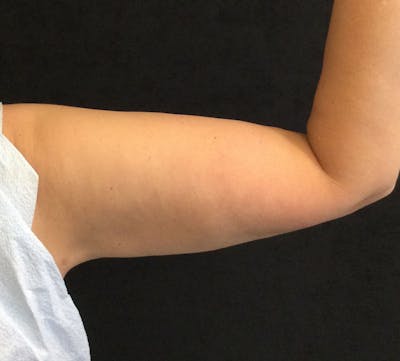 Bodytite Before & After Gallery - Patient 262913 - Image 2