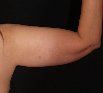Bodytite Before & After Gallery - Patient 262913 - Image 1