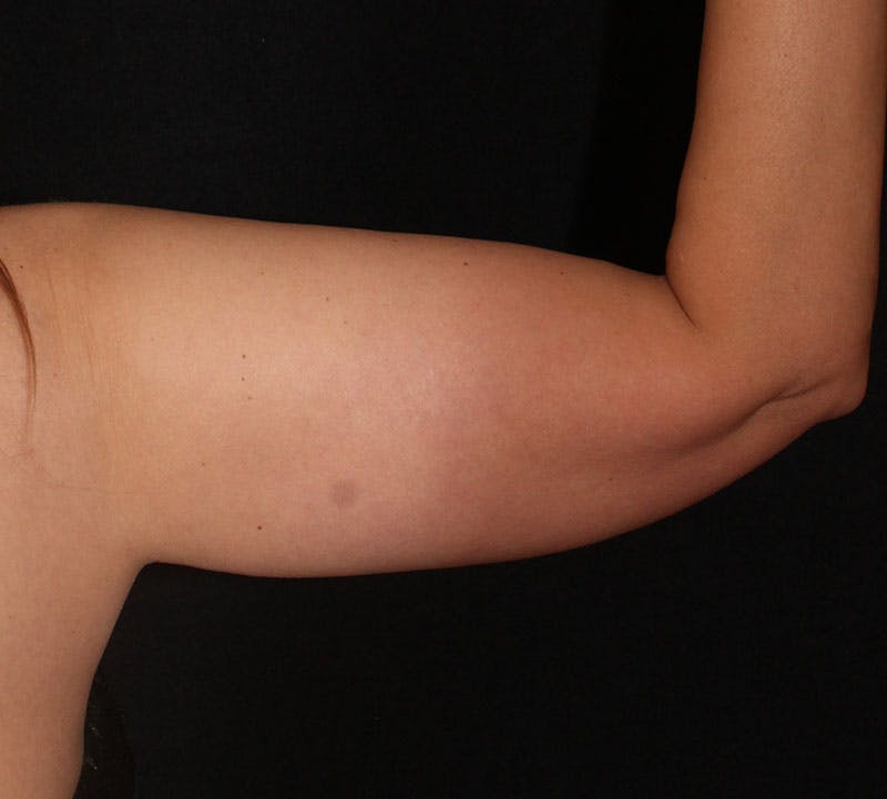 Bodytite Before & After Gallery - Patient 262913 - Image 1