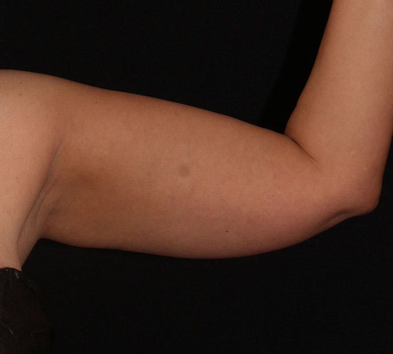 Bodytite Before & After Gallery - Patient 262913 - Image 3